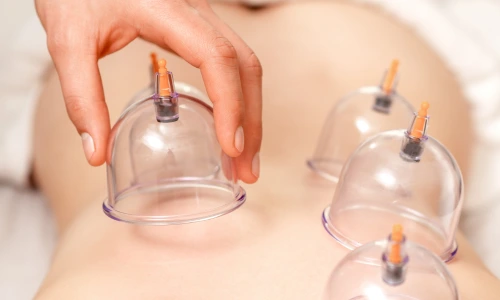 Cupping Therapy