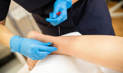 Needling